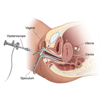 Hysteroscopic Polypectomy